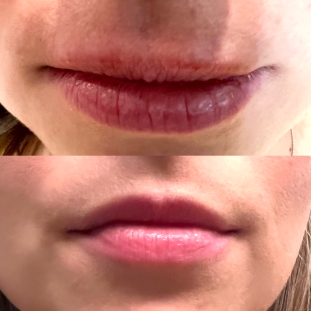 lip flip before and after